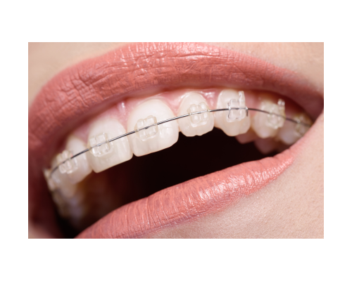 ceramic braces for teeth