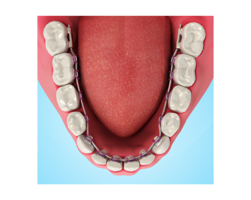 lingual braces for teeth