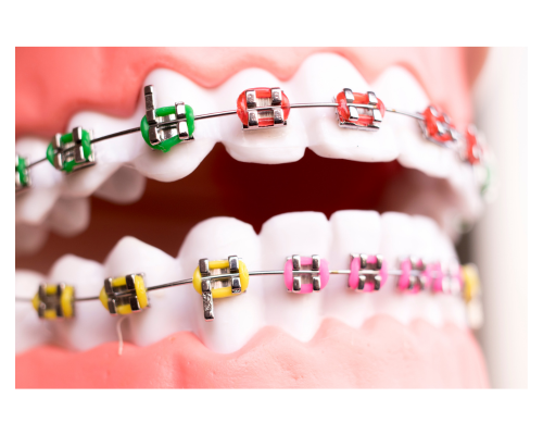 metal braces for teeth