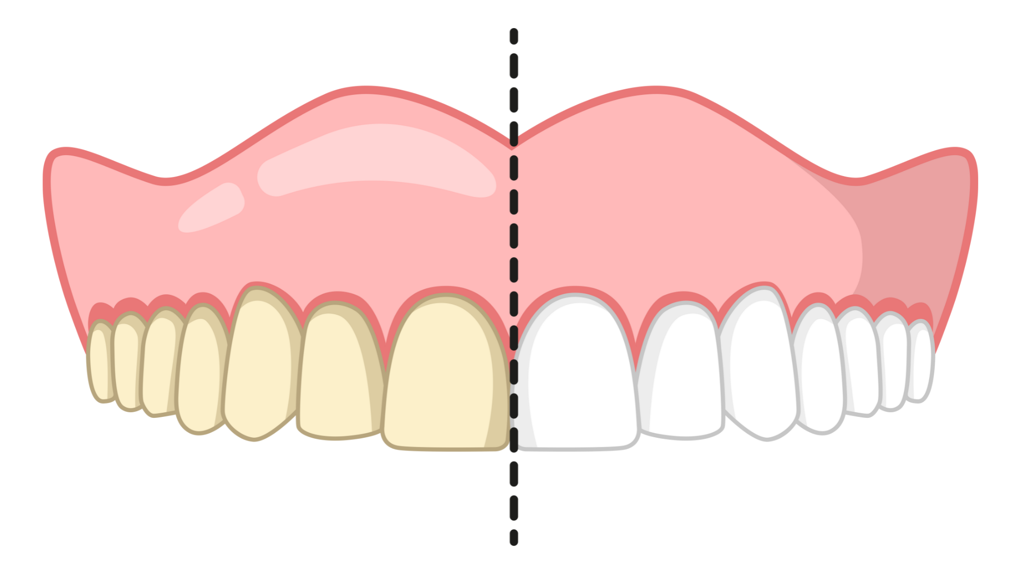 teeth whitening